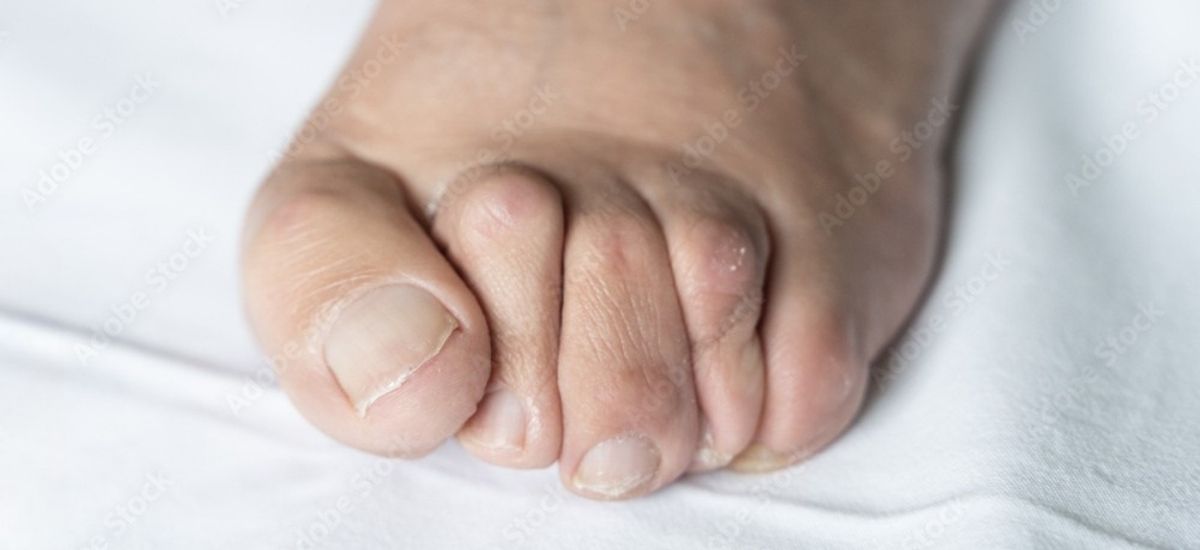 Hammer Toe Treatment